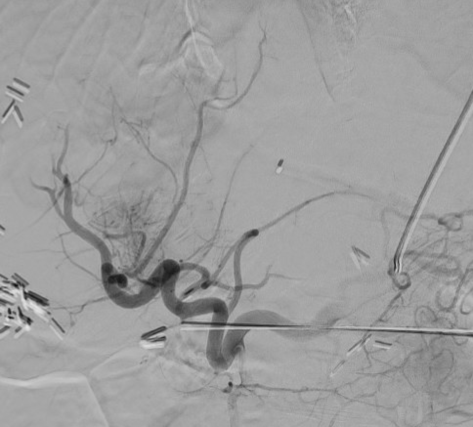 Interventional Radiology