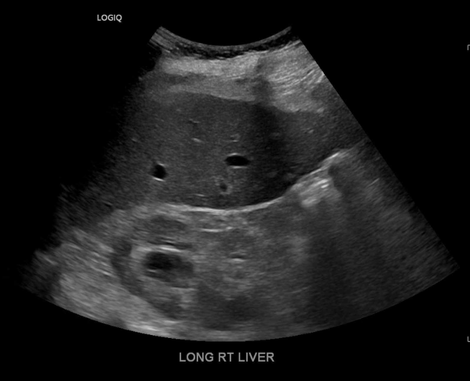 Ultrasound