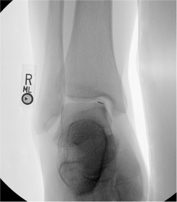 Ankle arthrogram needle placement at tibiotalar joint