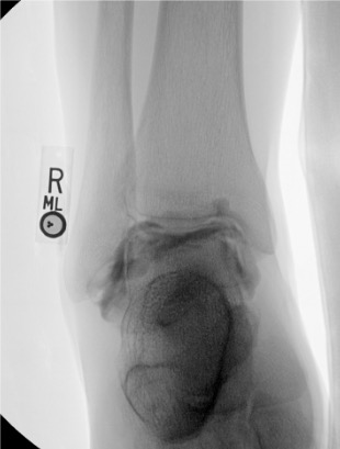 Ankle arthrogram post-injection