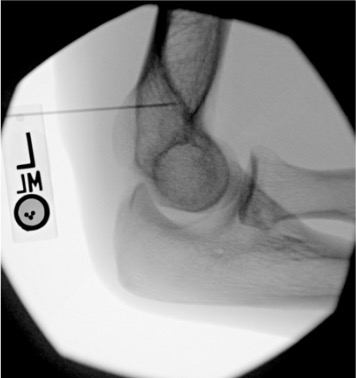 Elbow arthrogram needle placement at radiohumeral joint