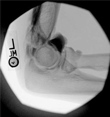 Elbow arthrogram post-injection