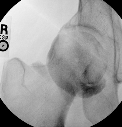 Hip arthrogram post-injection showing ring sign
