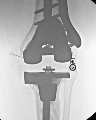 Knee arthrogram needle placement