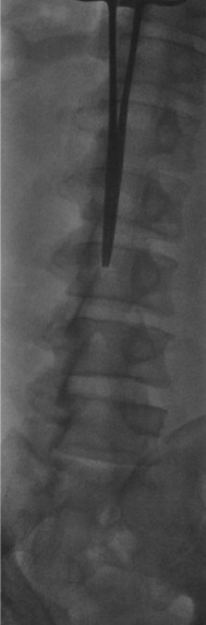 Prone oblique fluoroscopic view for lumbar puncture