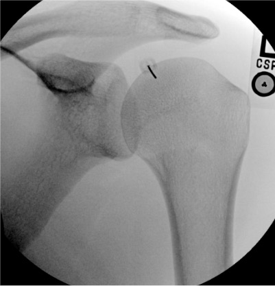 Shoulder arthrogram needle placement at rotator interval