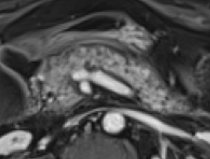 MRI showing acute interstitial edematous pancreatitis with loss of T1 signal and peripancreatic fluid