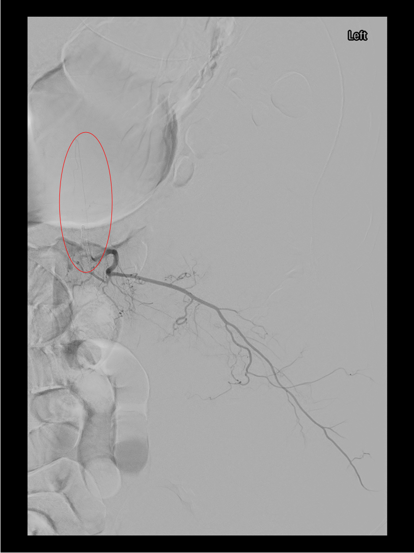 Anterior spinal artery hairpin sign on selective angiogram