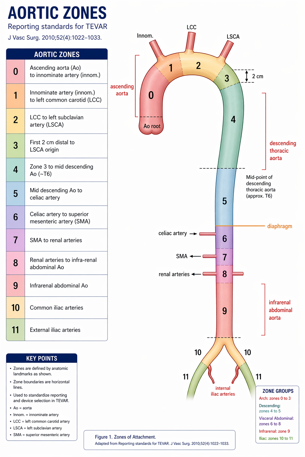 Aortic landing zone diagram for TEVAR showing Ishimaru zones 0–9 from the aortic root to the infrarenal aorta with arch vessel landmarks