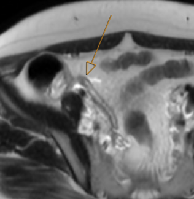 MRI T2W showing dilated appendix with periappendiceal fluid and wall thickening consistent with appendicitis