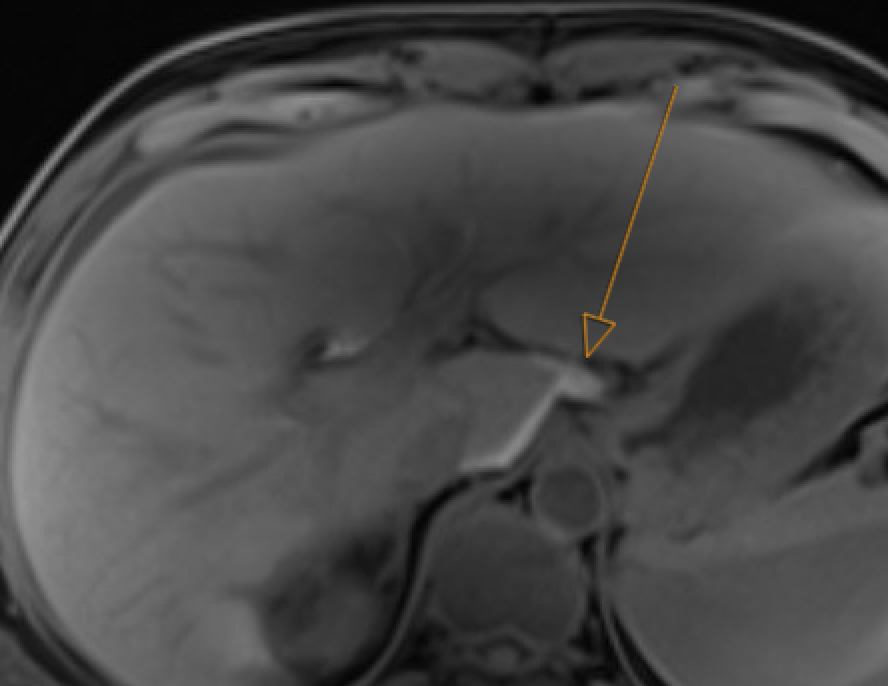Delayed gadoxetate MRI confirming bile extravasation into collection