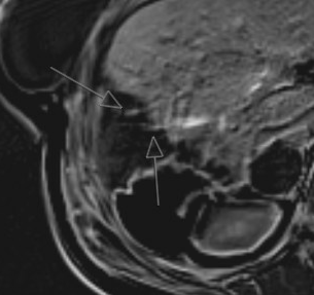 Gadoxetate hepatobiliary phase MRI showing bile leak extravasation