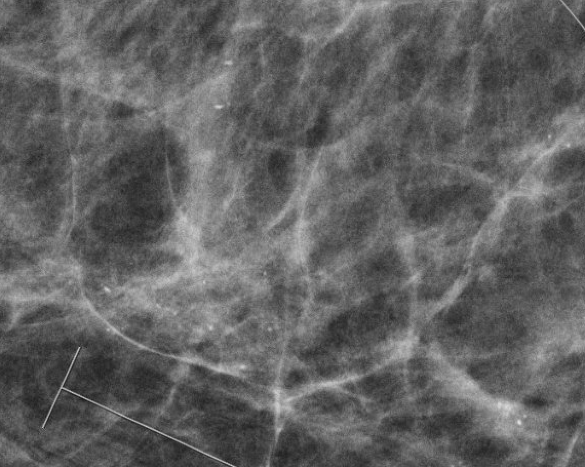 Amorphous calcifications