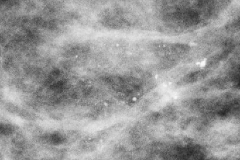 Coarse heterogeneous calcifications