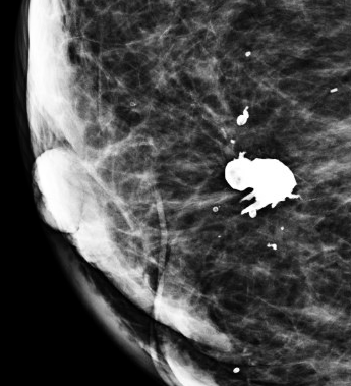 Dystrophic calcifications
