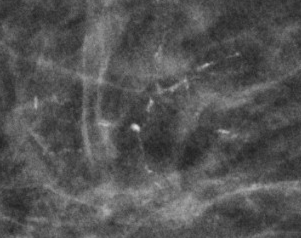 Fine linear / linear branching ("casting") calcifications