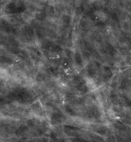 Fine pleomorphic calcifications