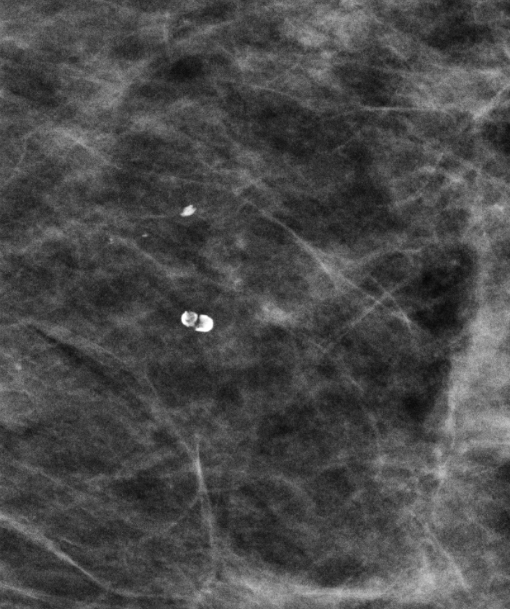 Lucent-centered calcifications