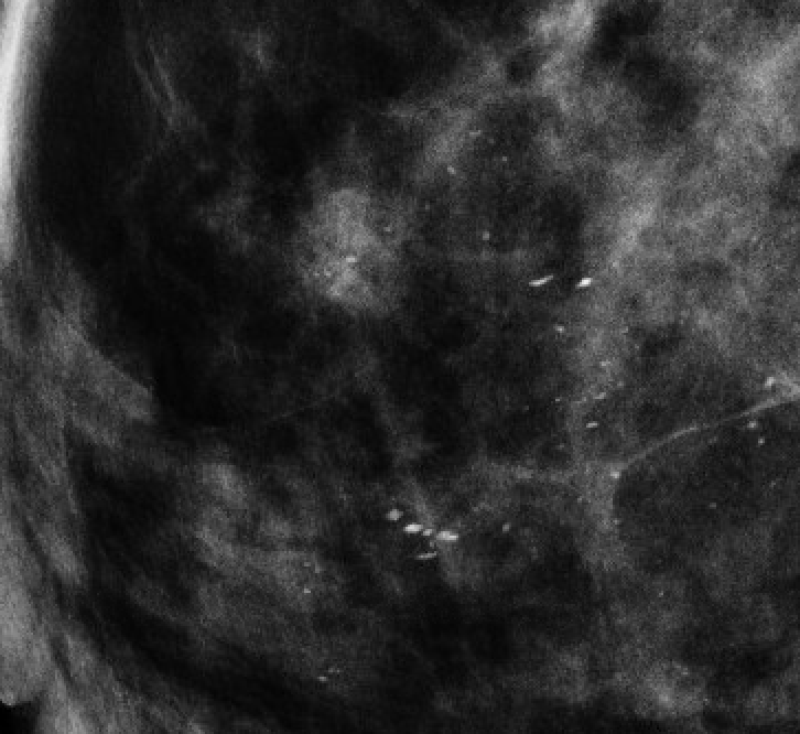 Milk of calcium calcifications