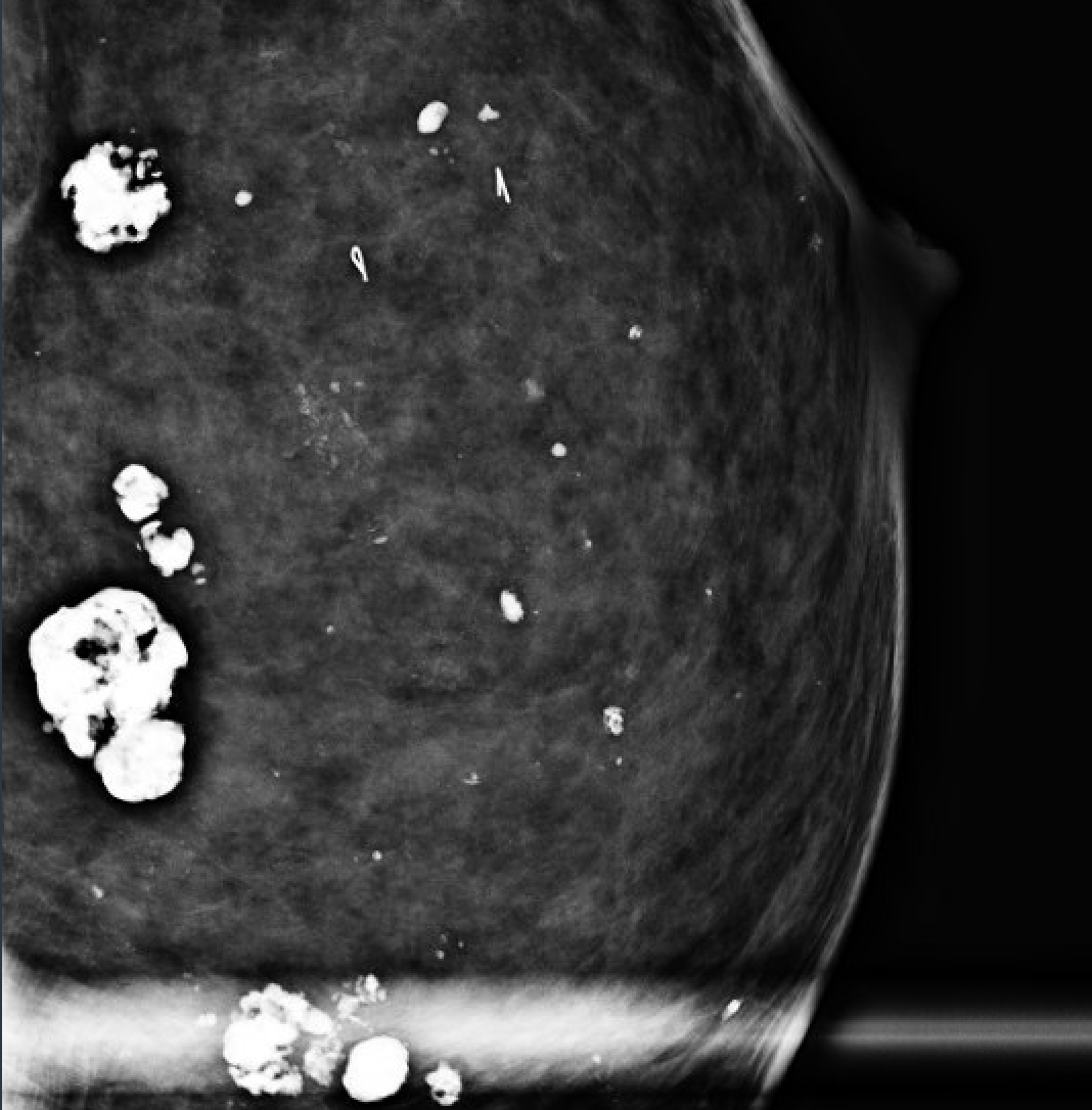 Coarse / "Popcorn" calcifications