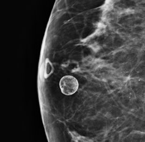 Rim (eggshell / lucent-centered) calcifications
