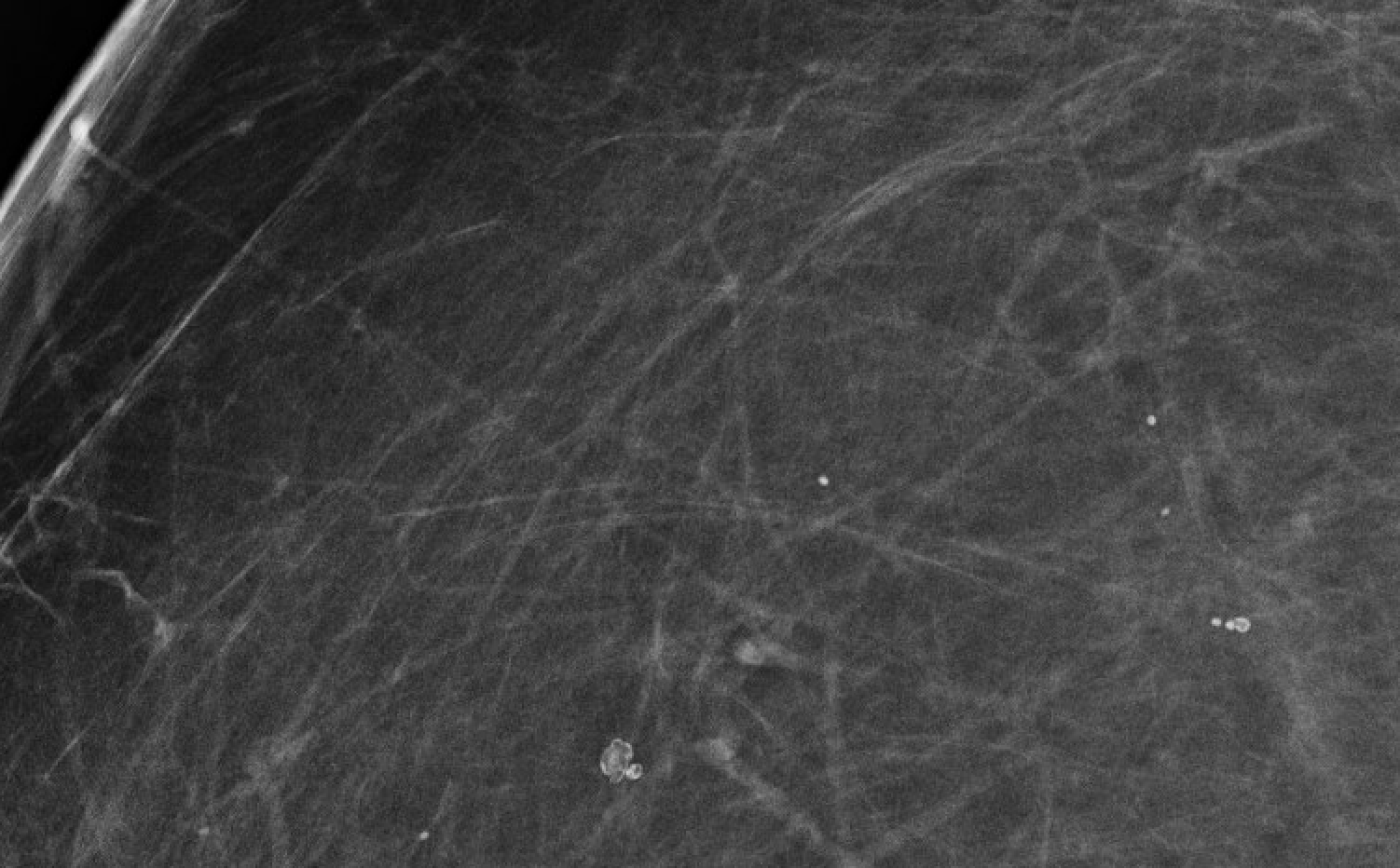 Round calcifications