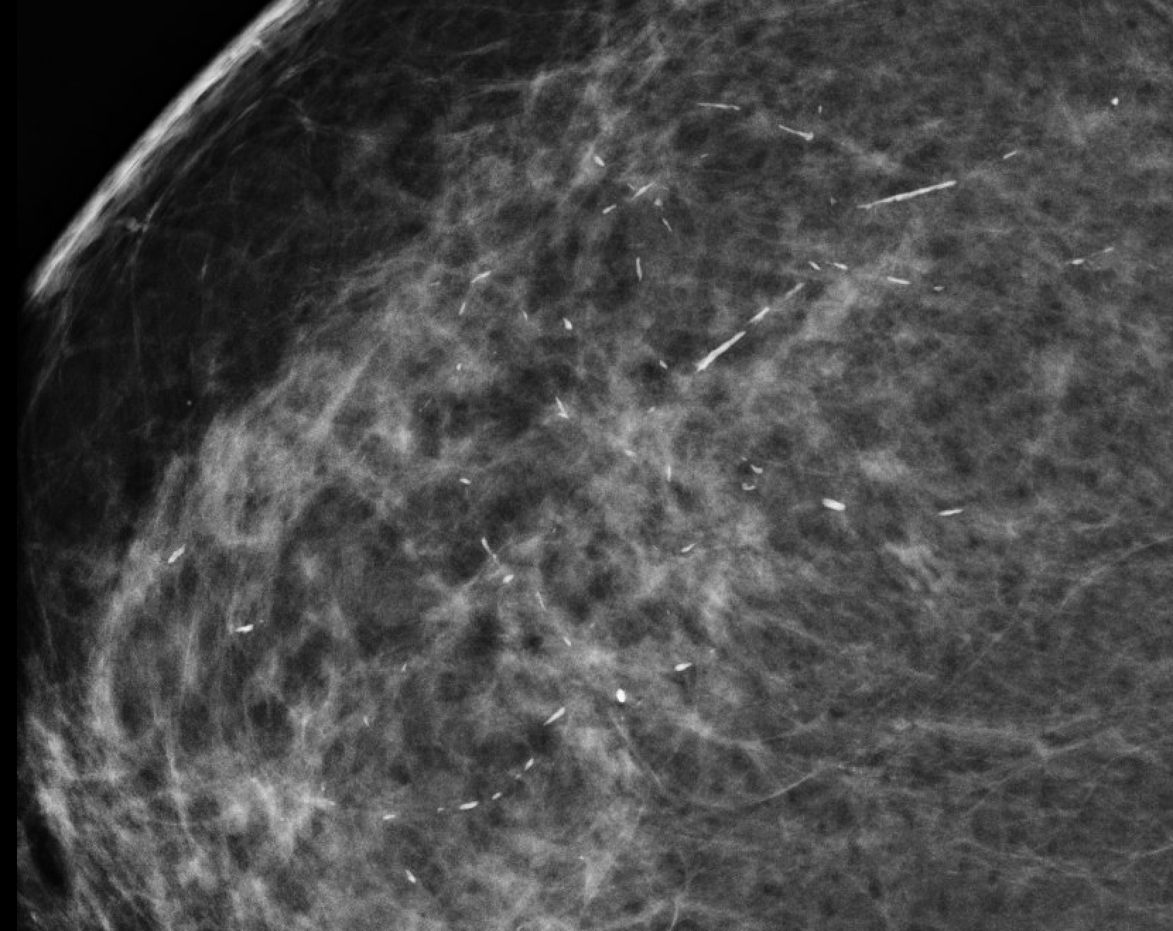 Large rod-like (secretory) calcifications