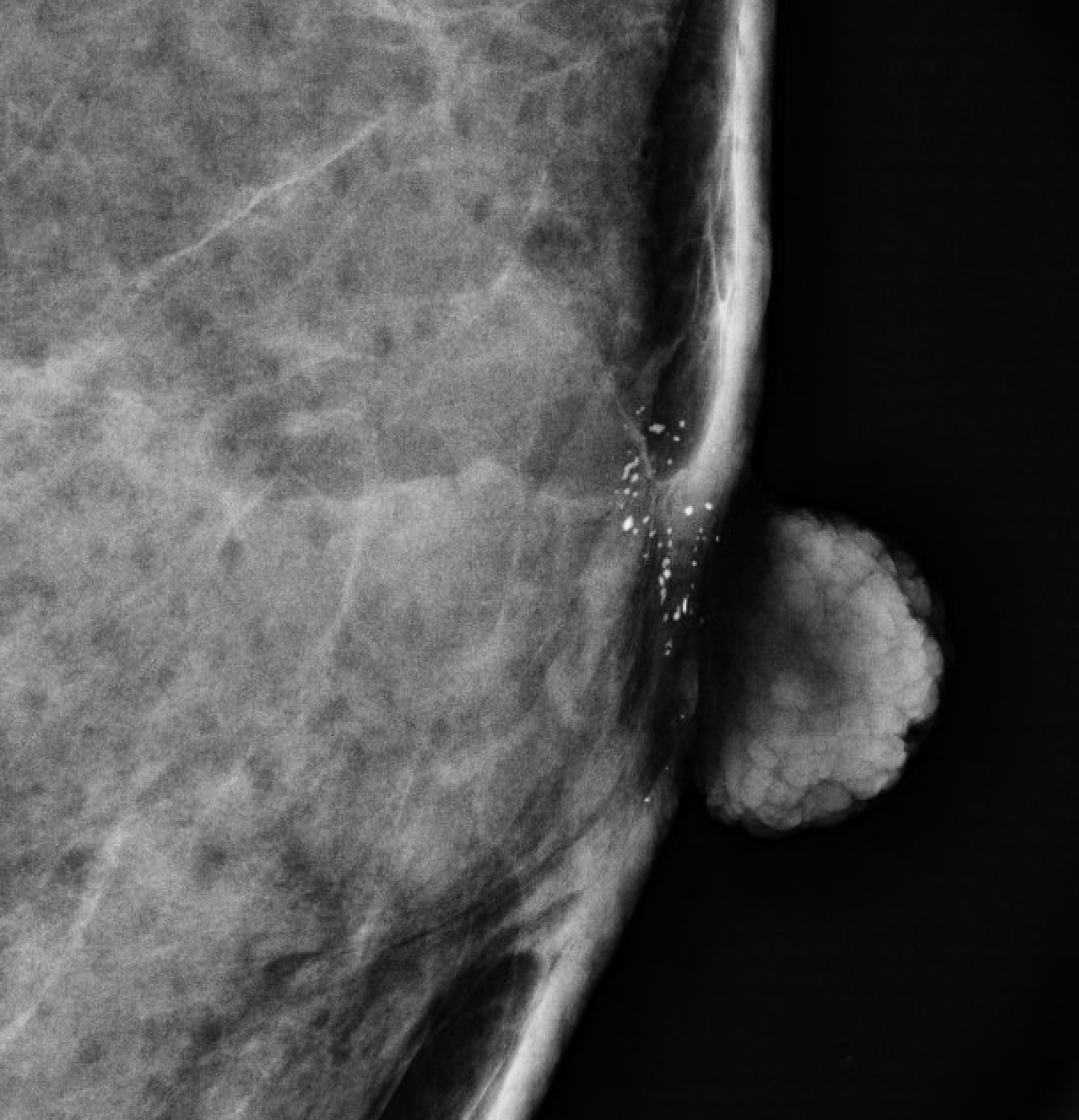 Skin (dermal) calcifications