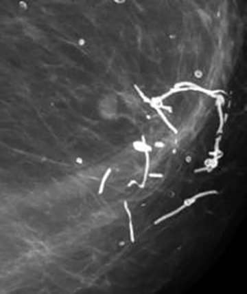 Suture calcifications