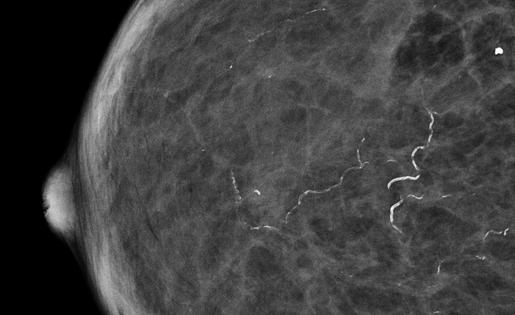 Vascular calcifications