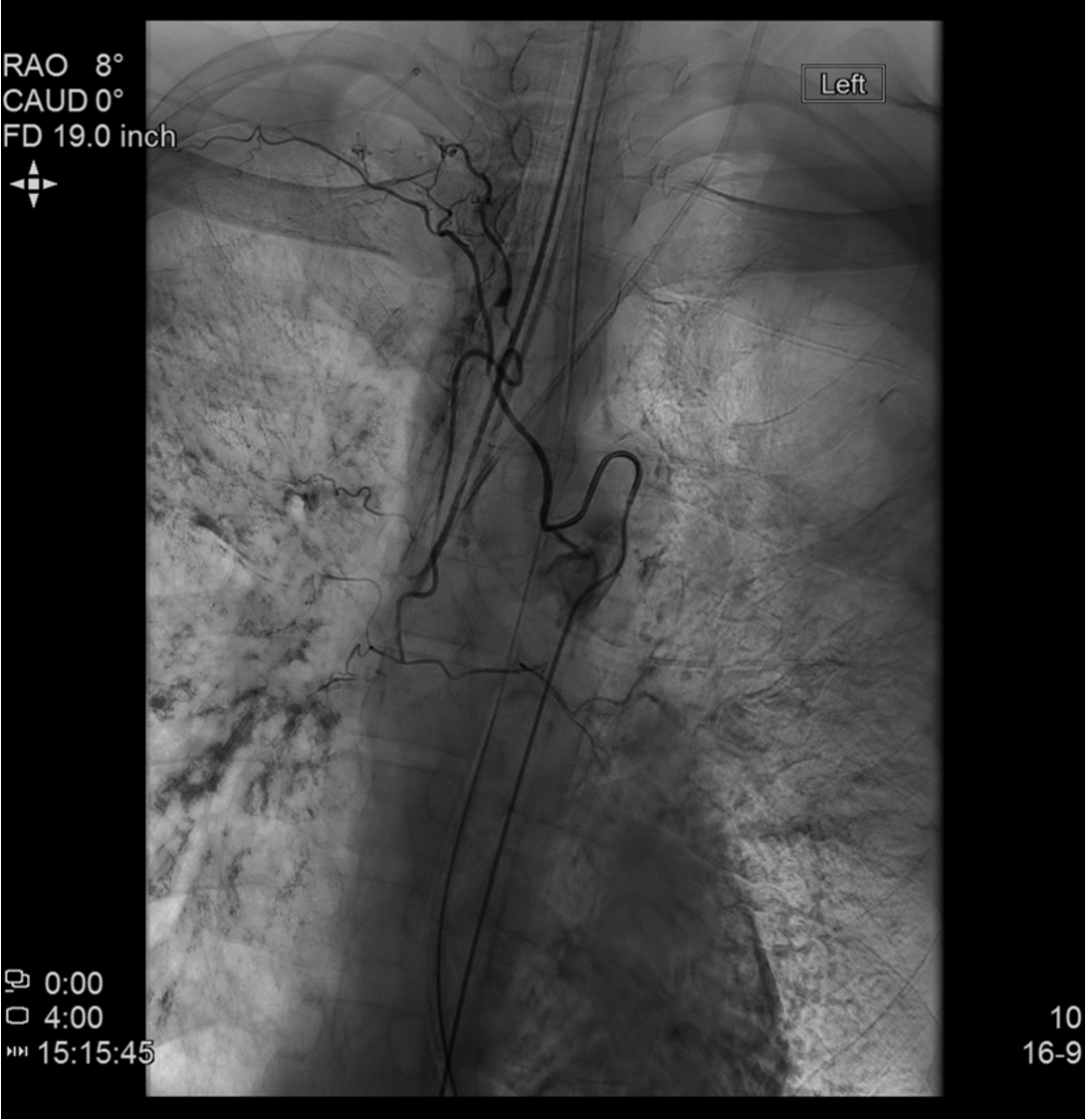 Bronchial artery embolization case angiogram