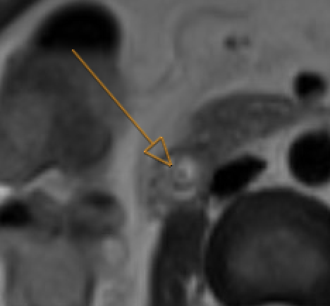 MRCP showing T2-hypointense filling defect in common bile duct consistent with choledocholithiasis