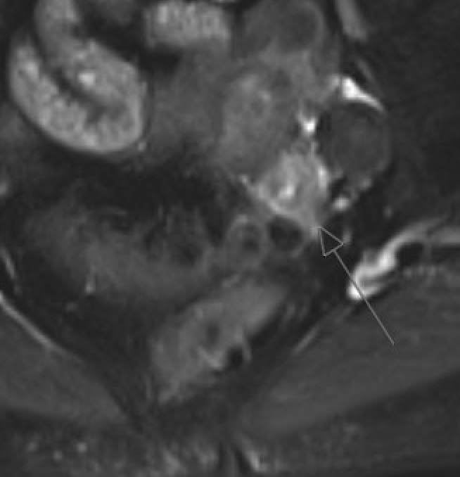 MRI showing sigmoid diverticulitis with colonic wall thickening and pericolic fat stranding on T2W fat-saturated sequence