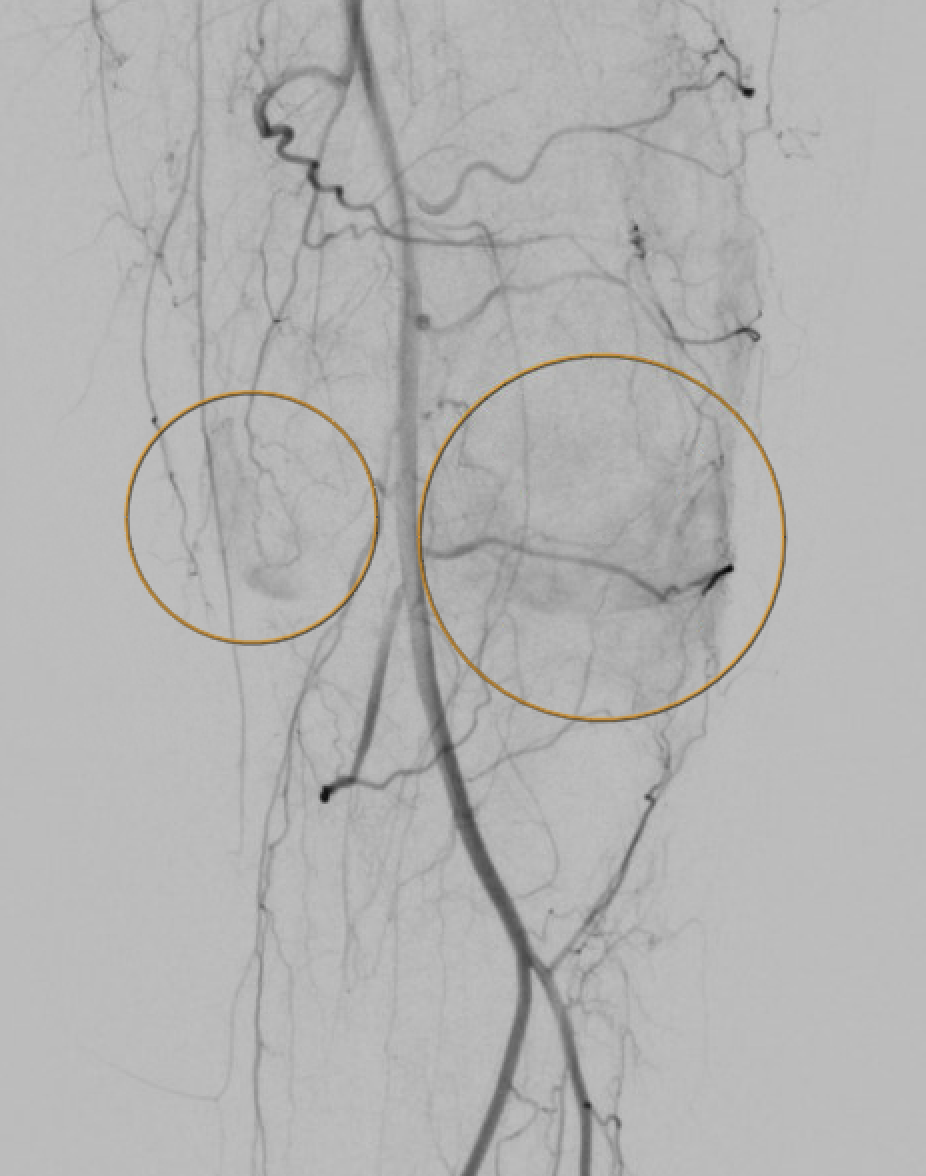 Genicular artery hypervascular synovial blush