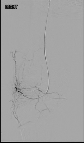 Inferior lateral genicular artery selective angiogram