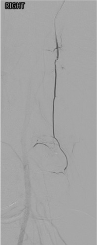 Superior medial genicular artery selective angiogram