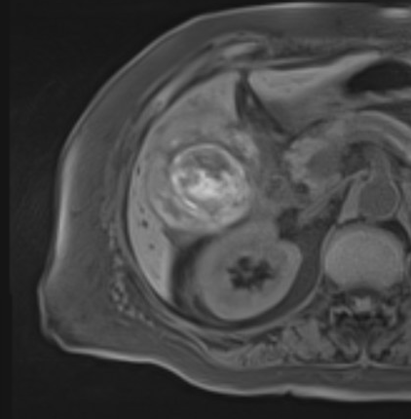 MRI T1W showing T1-hyperintense contents in gallbladder consistent with hemorrhagic cholecystitis