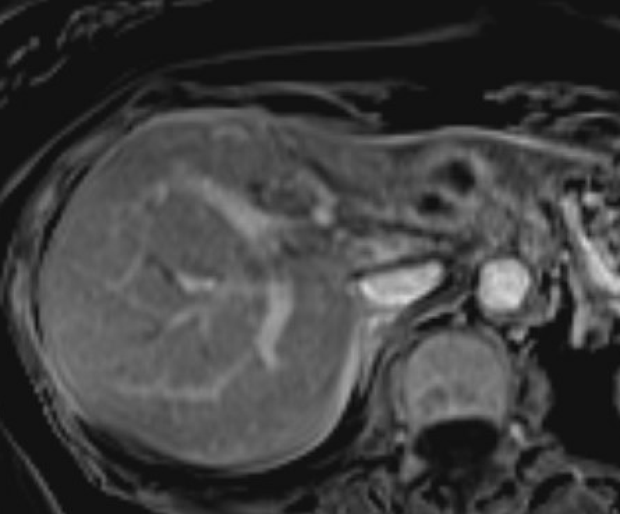 MRI showing hepatic abscess with rim enhancement and central diffusion restriction
