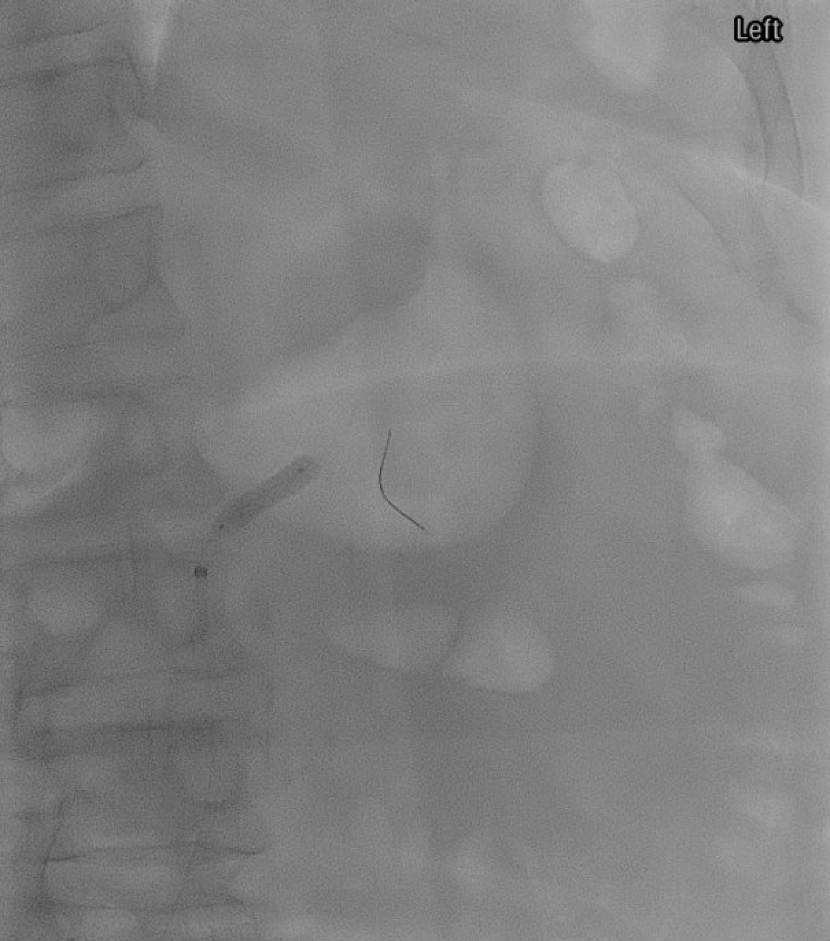 Left renal artery balloon angioplasty (PTA)