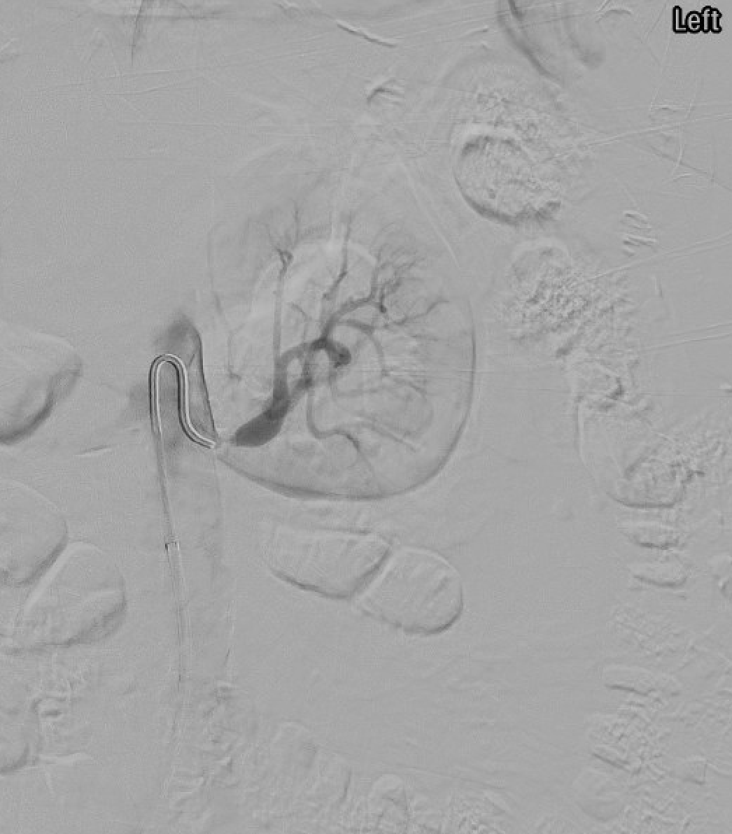Severe left renal artery stenosis on angiogram
