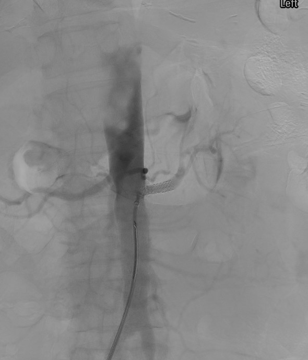 Left renal artery stent placement