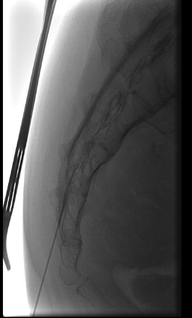 Caudal epidural injection through sacral hiatus