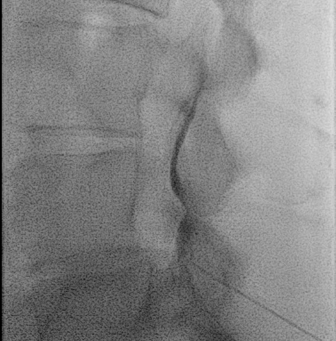 Contrast spread within the epidural space