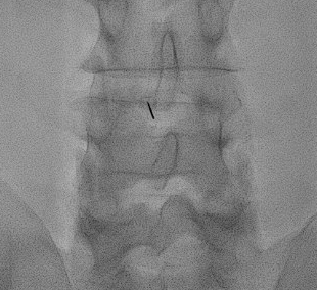 Lumbar epidural steroid injection overview