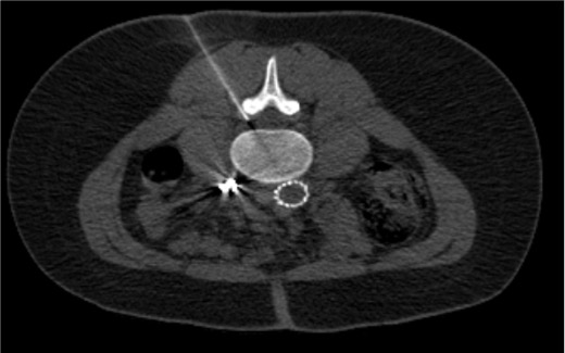 CT-guided lumbar epidural needle placement
