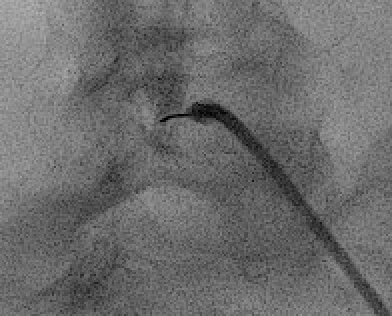 Scotty dog view on oblique fluoroscopy for TFESI