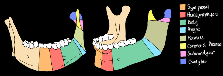 Mandible fracture regions — lateral and medial views: symphysis (tan), parasymphysis (orange-red), body (teal), angle (blue), ramus (olive), coronoid process (yellow), subcondylar (pink), condylar (blue-purple)
