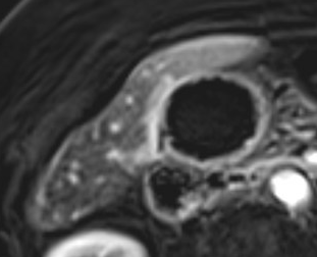MRI showing focal gallbladder wall nonenhancement consistent with gangrenous/necrotizing cholecystitis