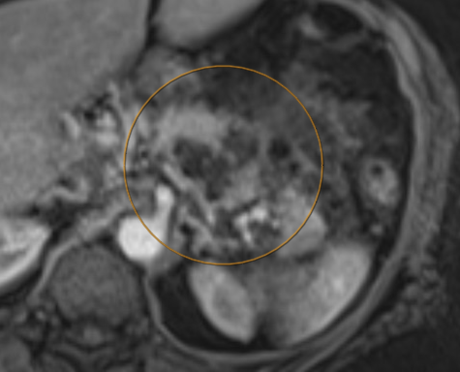 MRI showing acute necrotizing pancreatitis with lack of parenchymal enhancement