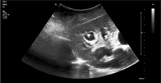 Ultrasound-guided nephrostomy needle access into posterior lower pole calyx